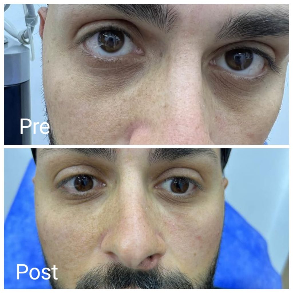 فيلر تحت العين لعلاج الهالات السوداء للرجال